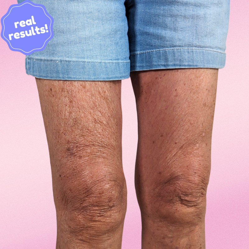 Auralift™ Beauty Strips